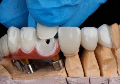Ceramic Dental Crowns