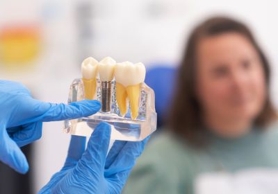 Dental Implants