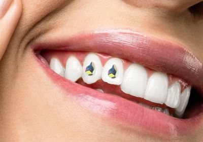 Dental Jewelry