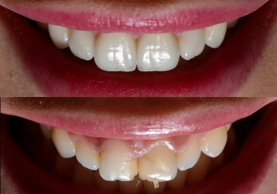 Smile Designing