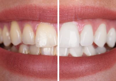 Teeth Whitening