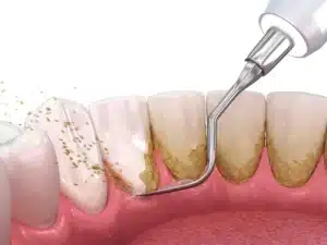 What is Teeth Scaling
